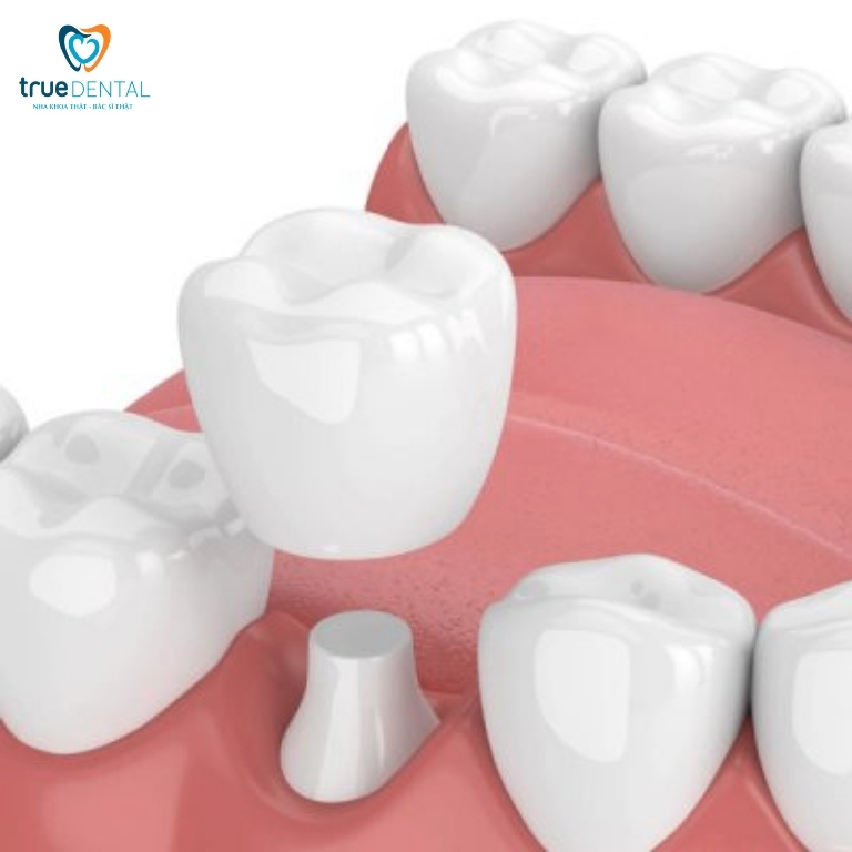 Răng lấy tủy có nên bọc răng sứ lại không? 5 Răng lấy tủy sau khi bọc sứ sử dụng được bao lâu?