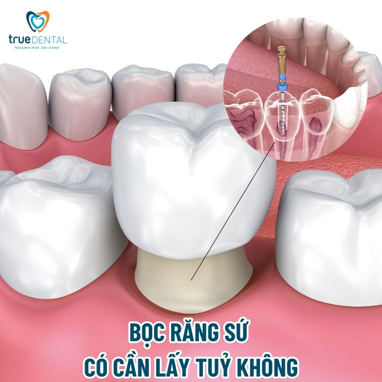 Răng lấy tủy có nên bọc răng sứ lại không? 3 Bọc răng sứ có cần lấy tủy không?
