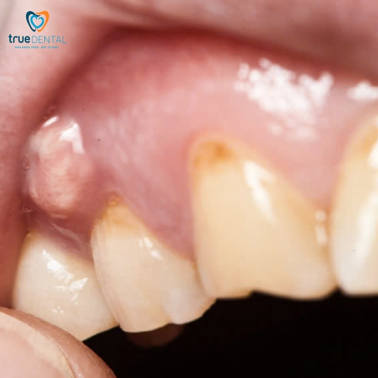 Sâu răng: Dấu hiệu, nguyên nhân, cách điều trị và phòng ngừa 9 biến chứng của bệnh sâu răng