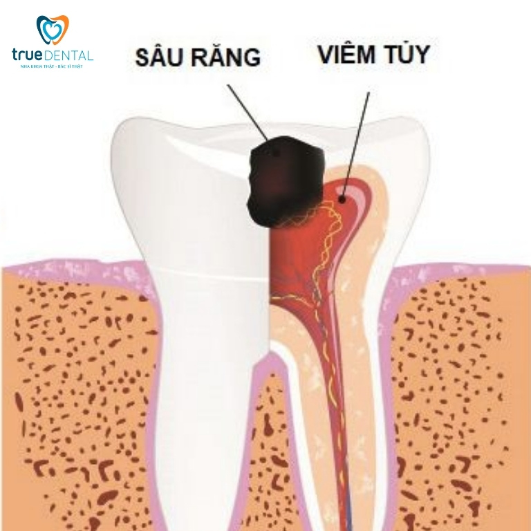 Sâu răng: Dấu hiệu, nguyên nhân, cách điều trị và phòng ngừa 8 Biến chứng có thể gặp khi mắc bệnh sâu răng