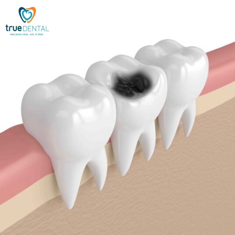 Sâu răng: Dấu hiệu, nguyên nhân, cách điều trị và phòng ngừa 1 sâu răng là gì?