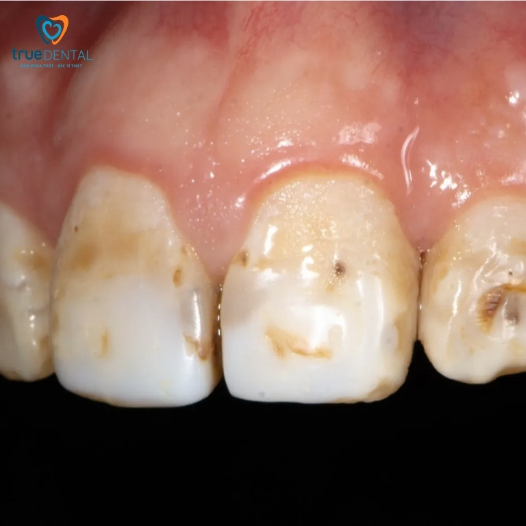 Sâu răng: Dấu hiệu, nguyên nhân, cách điều trị và phòng ngừa 5 Sâu bề mặt răng