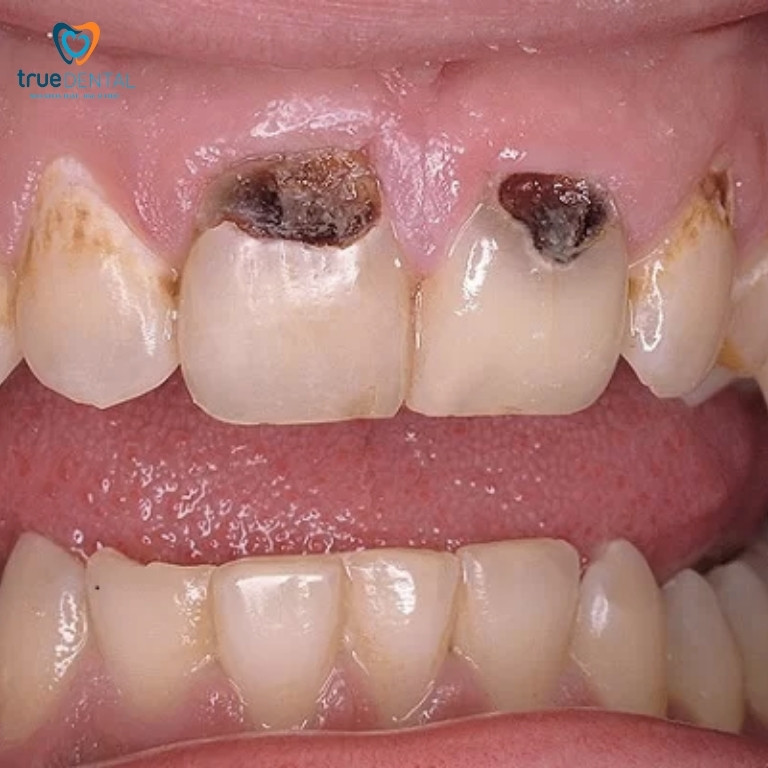 Sâu răng: Dấu hiệu, nguyên nhân, cách điều trị và phòng ngừa 3 Phân loại sâu răng