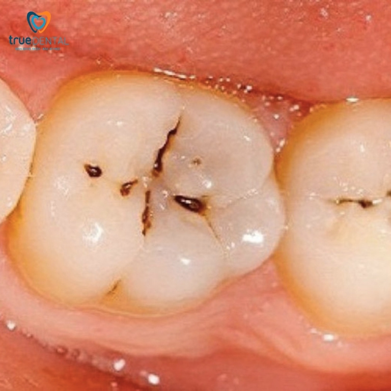 Sâu răng: Dấu hiệu, nguyên nhân, cách điều trị và phòng ngừa 4 Sâu hố rãnh răng
