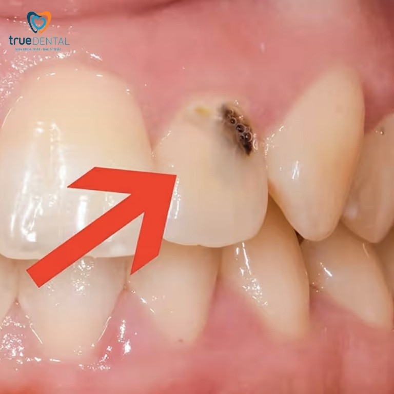 Sâu răng: Dấu hiệu, nguyên nhân, cách điều trị và phòng ngừa 2 Triệu chứng bệnh Sâu răng