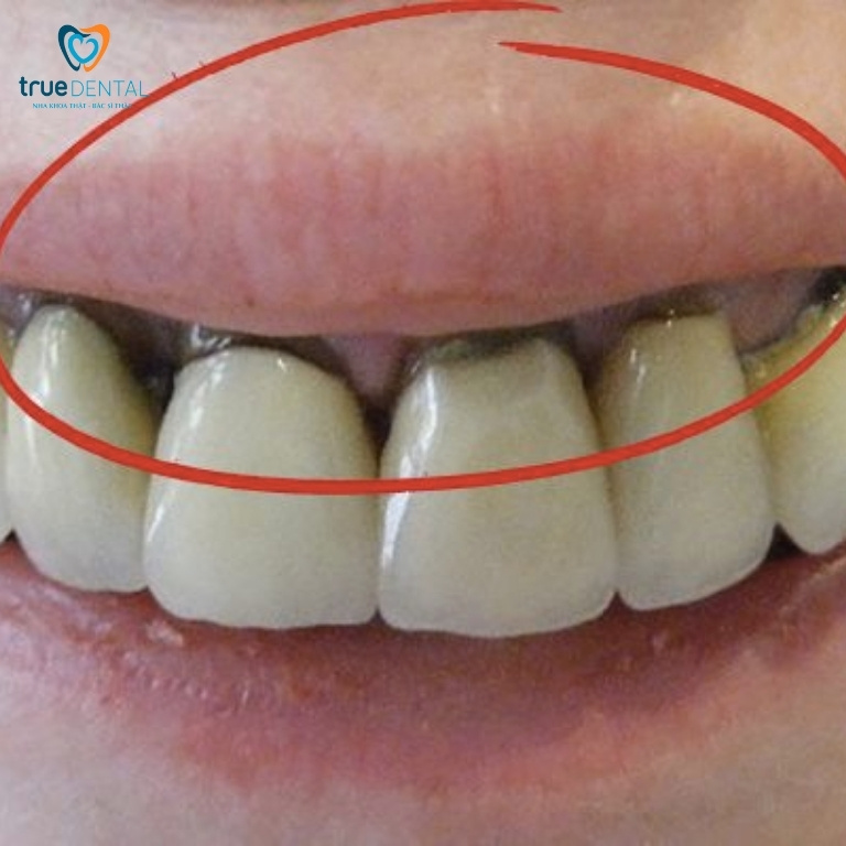 Răng có vết đen: Nguyên nhân, cách chữa trị và phòng ngừa 6 Do miếng dán veneer hoặc mão sứ khiến răng bị đen