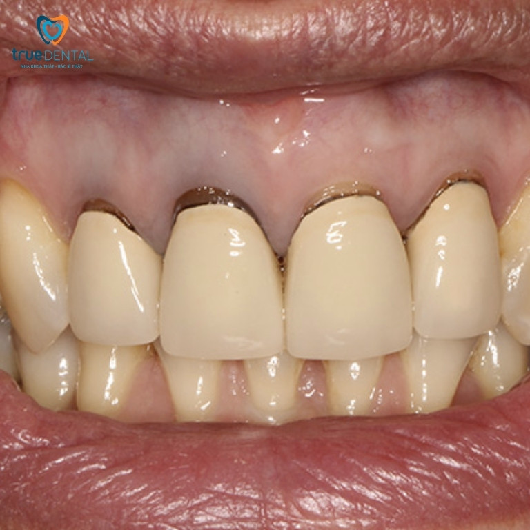 10 Tác hại bọc răng sứ bạn nên biết trước khi làm 5 Răng sứ bị lung lay