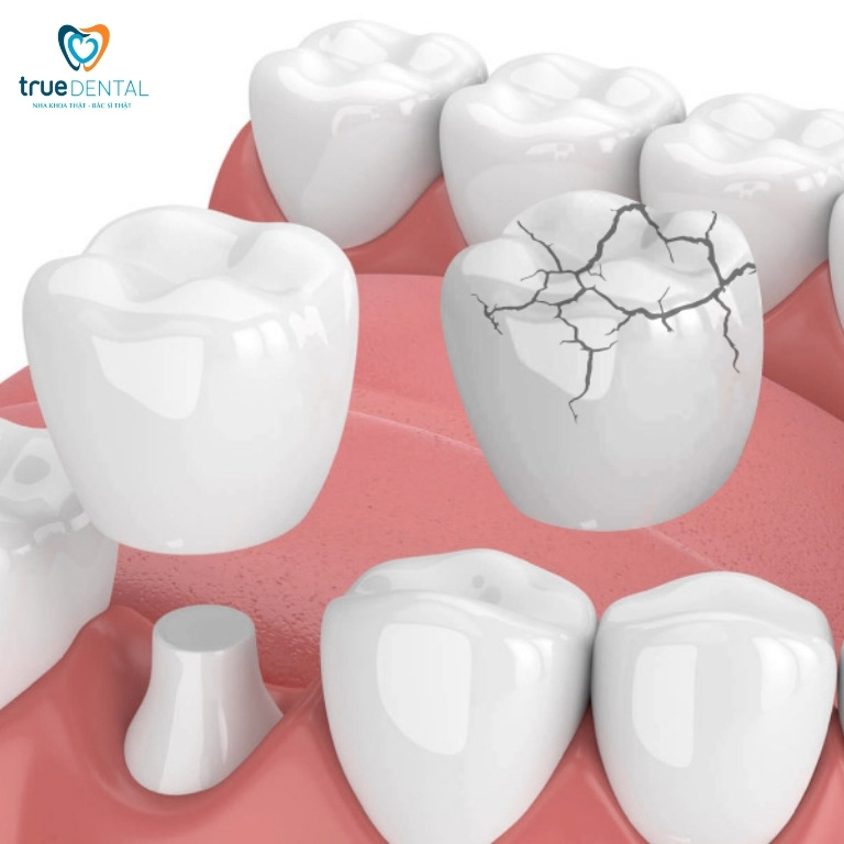 10 Tác hại bọc răng sứ bạn nên biết trước khi làm 3 tác hại bọc răng sứ bị nứt, vỡ