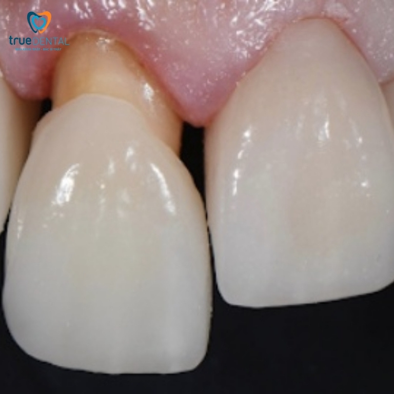 10 Tác hại bọc răng sứ bạn nên biết trước khi làm 6 Răng sứ bị rơi, rớt