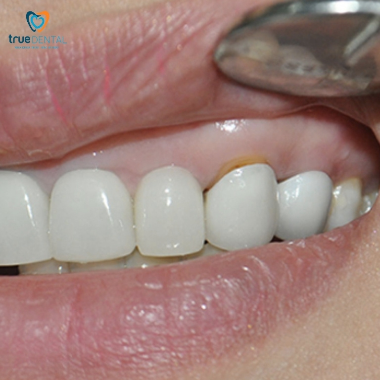 10 Tác hại bọc răng sứ bạn nên biết trước khi làm 4 tác hại bọc sứ hở cổ chân răng