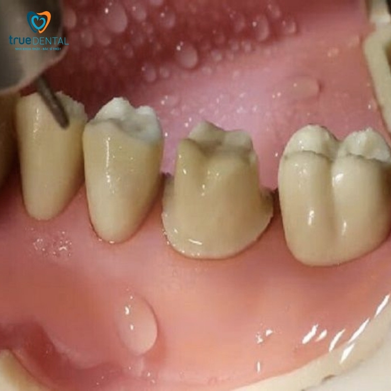 10 Tác hại bọc răng sứ bạn nên biết trước khi làm 2 tác hại bọc răng sứ sai kỹ thuật cần biết