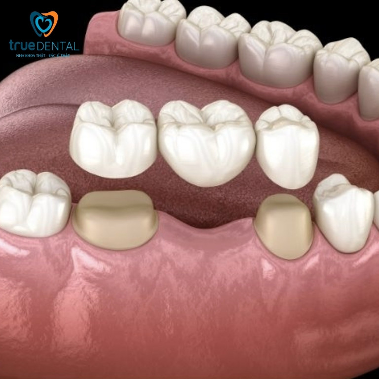 Trồng răng sứ có đau không? Bao lâu thì hết đau? 1 Trồng răng sứ có đau không?