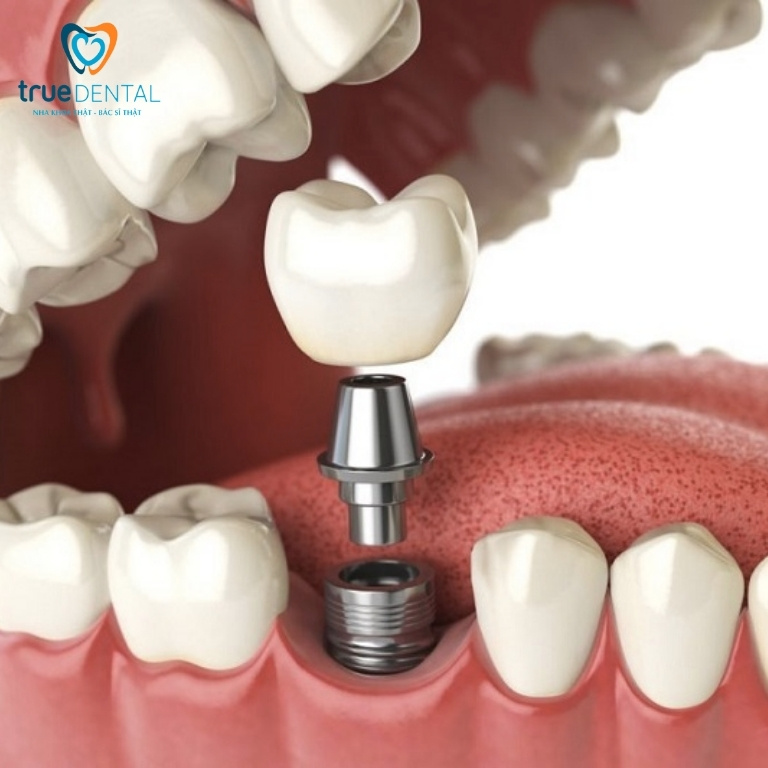 Trồng răng sứ có đau không? Bao lâu thì hết đau? 2 Trồng răng implant phục hình răng sứ có đau không?