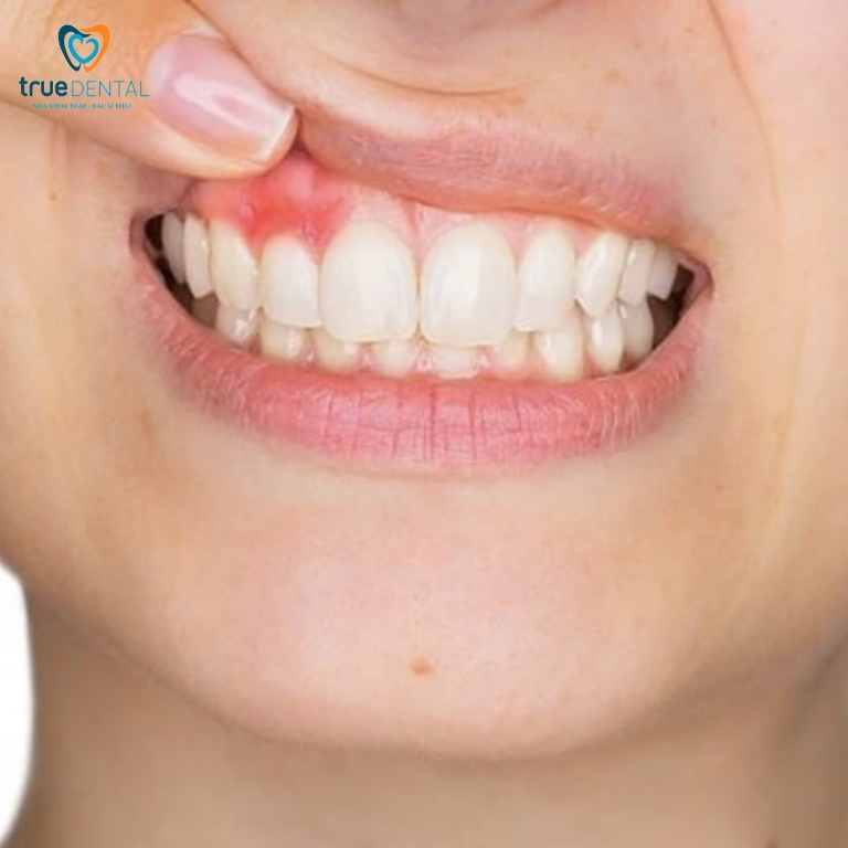 Viêm quanh cuống răng: Nguyên nhân và cách chữa trị 4 Viêm nha chu có lây không?