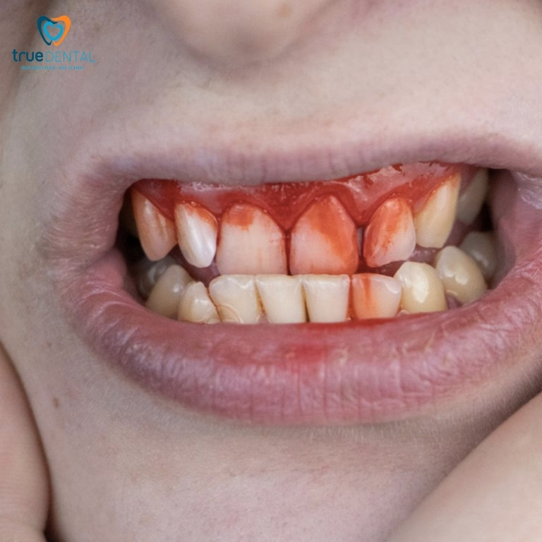 Viêm nha chu: Dấu hiệu, nguyên nhân và cách điều trị 7 Viêm nha chu có nguy hiểm không? 10 biến chứng cần biết