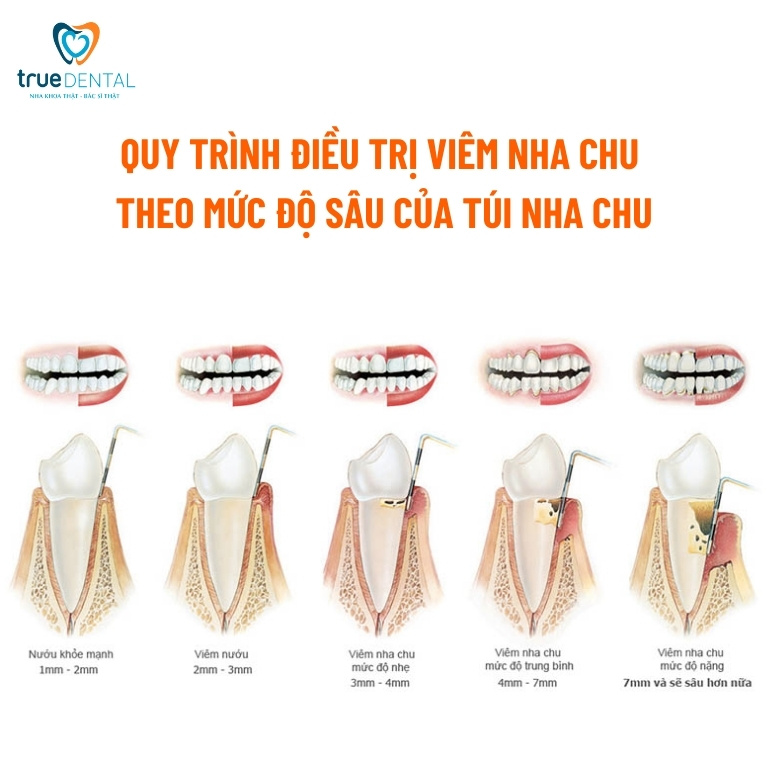 Viêm nha chu: Dấu hiệu, nguyên nhân và cách điều trị 10 phương pháp điều trị bệnh viêm nha chu