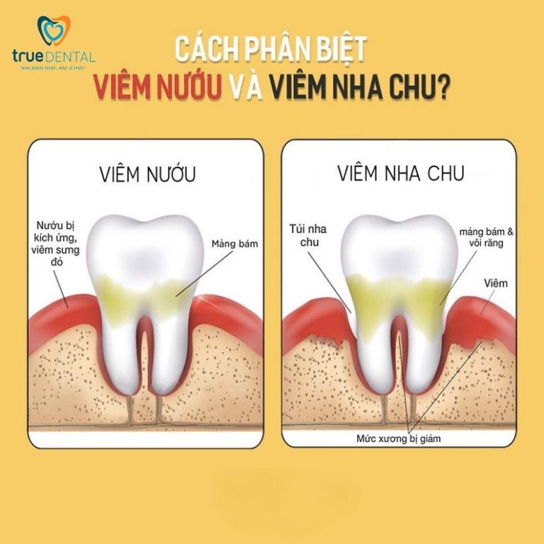 Viêm nha chu: Dấu hiệu, nguyên nhân và cách điều trị 4 Viêm nha chu và viêm nướu có gì khác nhau?