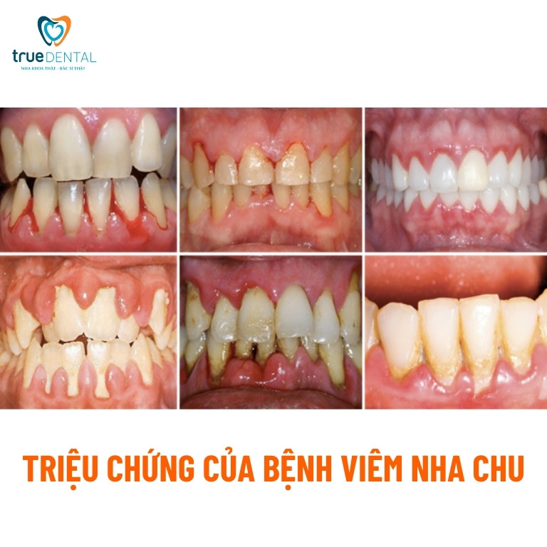 Viêm nha chu: Dấu hiệu, nguyên nhân và cách điều trị 2 Triệu chứng của bệnh viêm nha chu