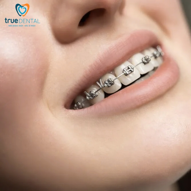 Mắc cài kim loại có mấy loại? Giá từng loại là bao nhiêu? 1 Tổng quan về niềng răng mắc cài kim loại