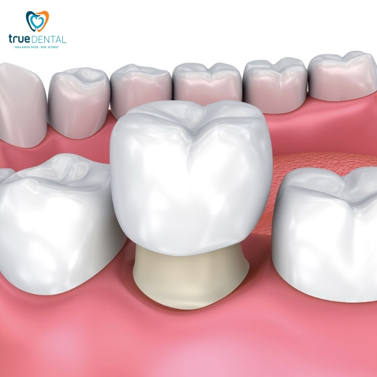 Trị móm tại nhà bằng cách nào? Có nên tự điều trị tại nhà không? 4 Bọc răng sứ chữa móm