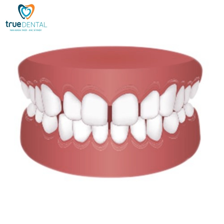 Các loại móm phổ biến và cách điều trị 1 Thế nào là răng móm?