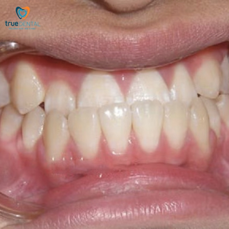 Niềng răng móm mất bao lâu thì xong? Chi phí ra sao? 3 Phân loại theo khớp cắn