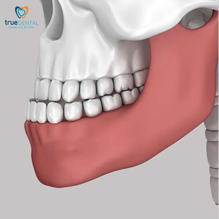 Các loại móm phổ biến và cách điều trị 4 Phân loại theo nguyên nhân