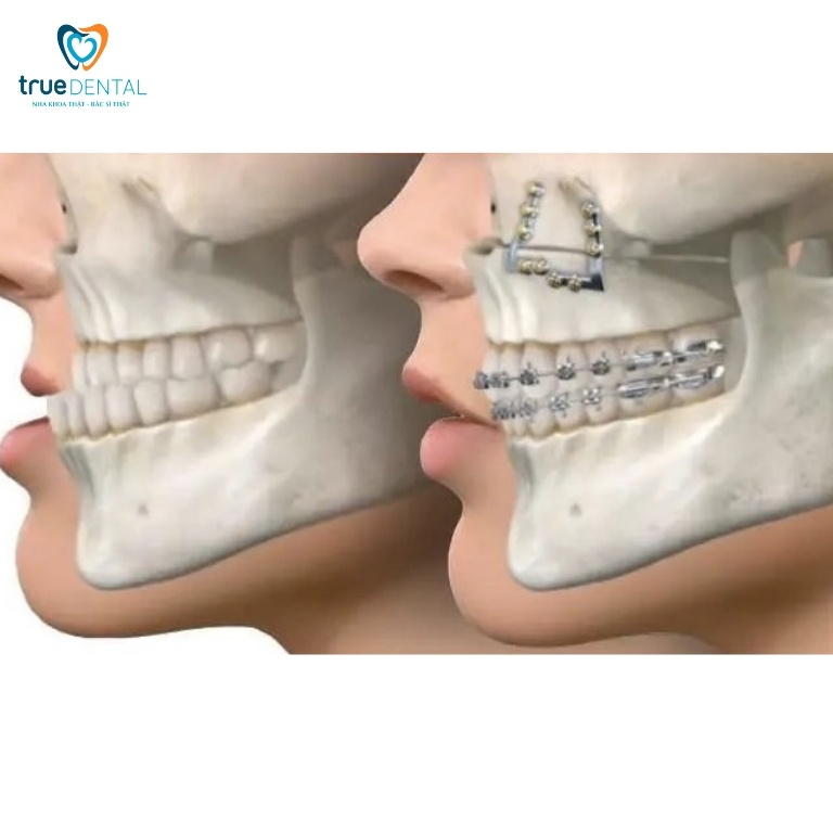 Các loại móm phổ biến và cách điều trị 6 phương pháp điều trị các loại móm hiệu quả