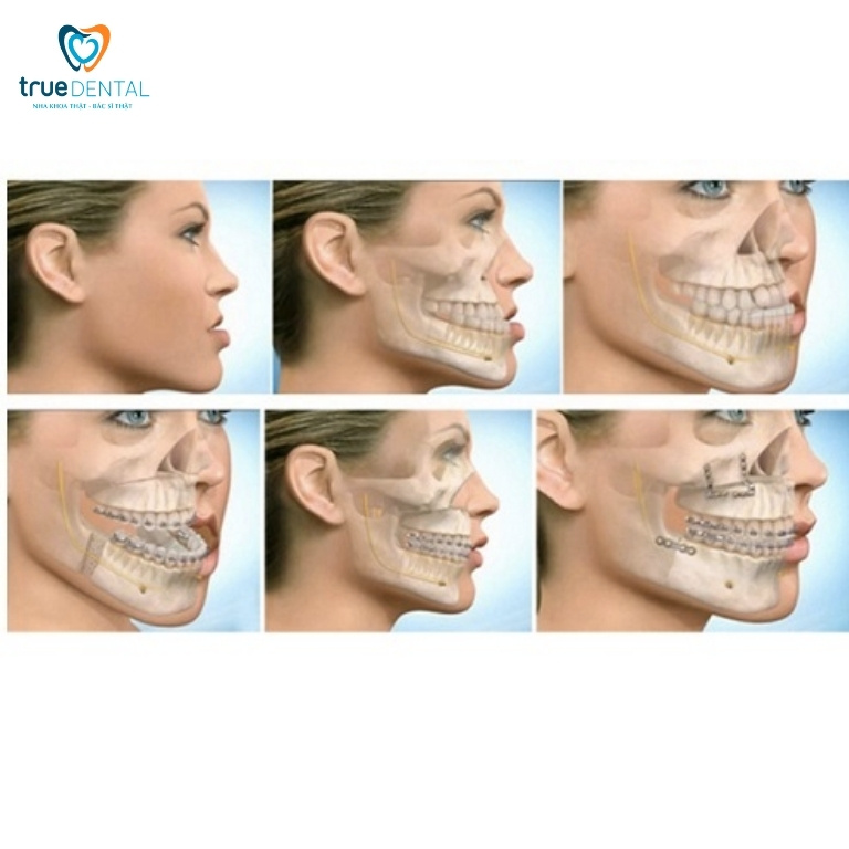 Các loại móm phổ biến và cách điều trị 7 Niềng răng kết hợp phẫu thuật hàm