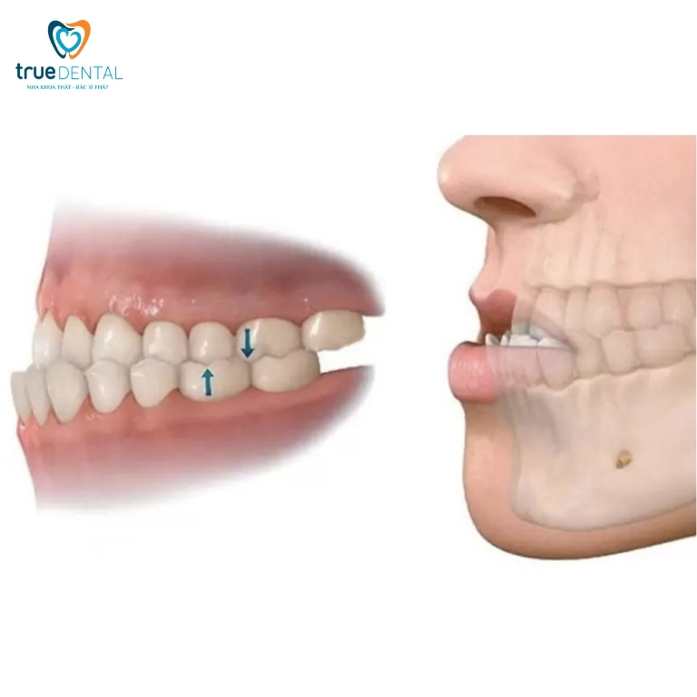 Các loại móm phổ biến và cách điều trị 2 Phân loại các loại móm phổ biến hiện nay