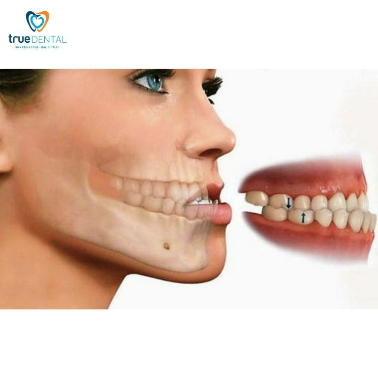 Niềng răng móm mất bao lâu thì xong? Chi phí ra sao? 1 tác hại mà các loại móm gây ra