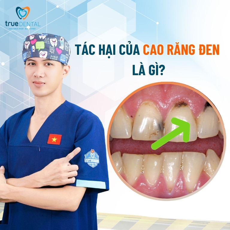 Cao răng đen: Nguyên nhân, tác hại và cách chữa trị 4 Tác hại của cao răng đen là gì?