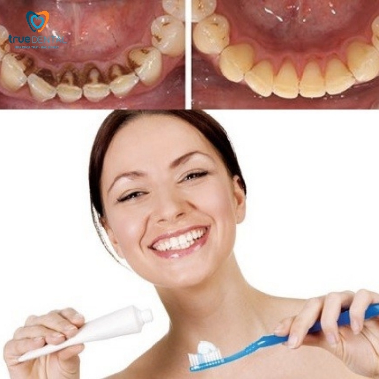 Cao răng độ 3 nguy hiểm thế nào? Cách xử lý hiệu quả 8 Những lưu ý khi vệ sinh chăm sóc răng sau khi lấy cao răng