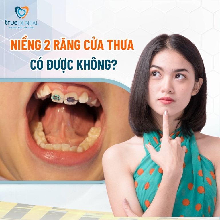 Chi phí niềng răng cửa thưa bao nhiêu tiền? Mất bao lâu? 1 Niềng 2 răng cửa thưa có được không?