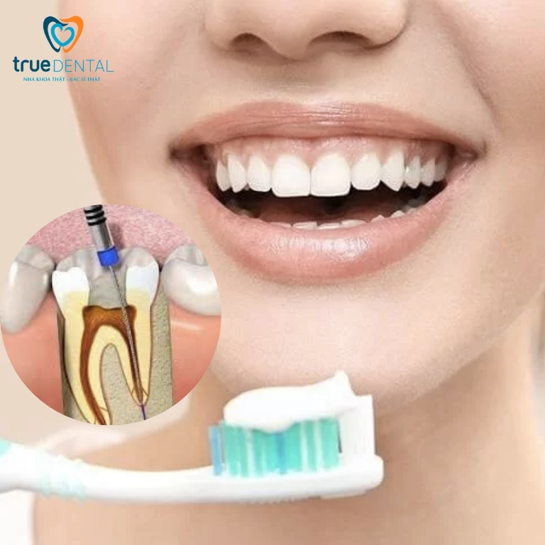 Chữa tủy răng cửa: Những điều cần biết 5 Hướng dẫn chăm sóc răng sau khi lấy tuỷ răng cửa