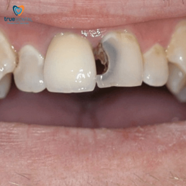 Chữa tủy răng cửa: Những điều cần biết 2 Khi nào cần điều trị tuỷ răng cửa?