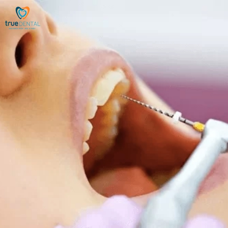 Chữa tủy răng cửa: Những điều cần biết 1 Thế nào là chữa tuỷ răng cửa?