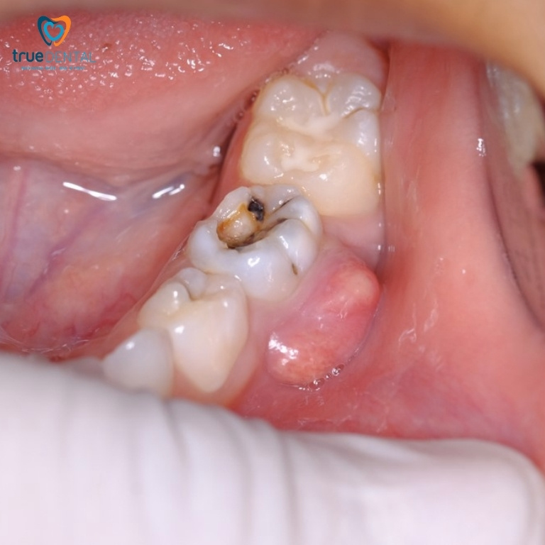 Có nên chữa tủy răng sữa? Quy trình các bước, những điều cần biết 2 Dấu hiệu viêm tủy răng sữa