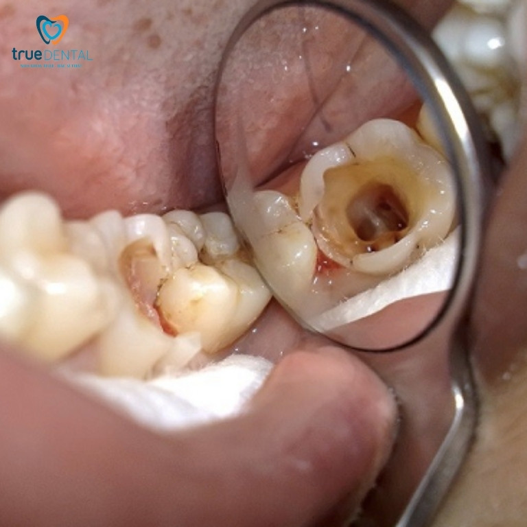 Có nên chữa tủy răng sữa? Quy trình các bước, những điều cần biết 3 Biến chứng khi răng sữa bị viêm tủy