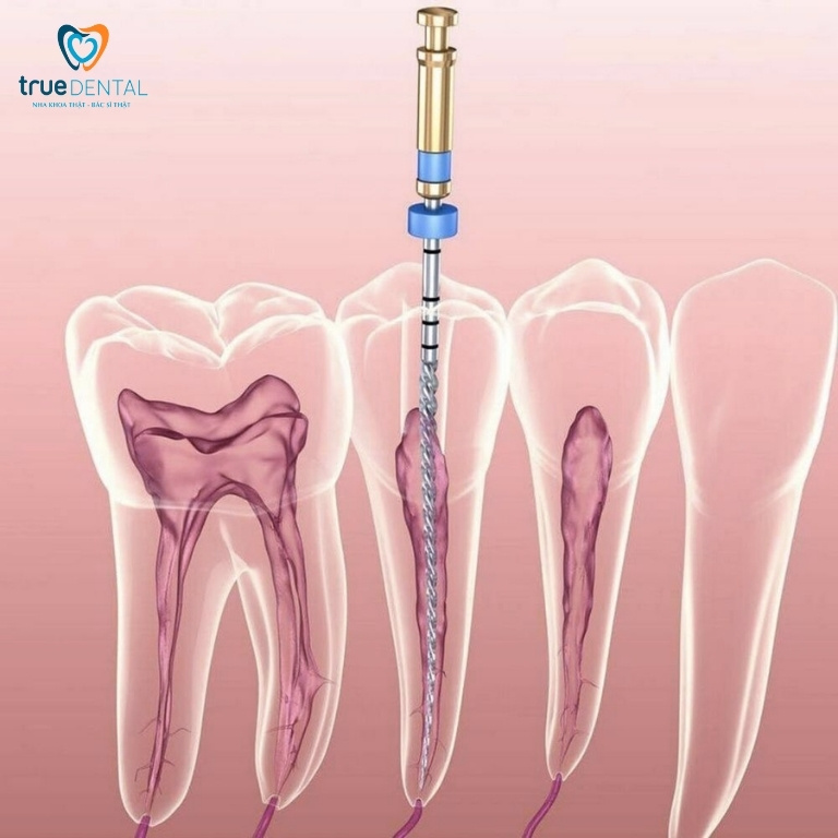 Có nên chữa tủy răng sữa? Quy trình các bước, những điều cần biết 5 Các phương pháp điều trị tủy ở răng sữa
