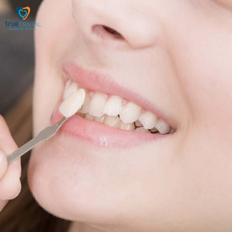 Có nên dán mặt răng sứ? Trường hợp nào nên dán sứ Veneer 1 Thế nào là dán mặt răng sứ?