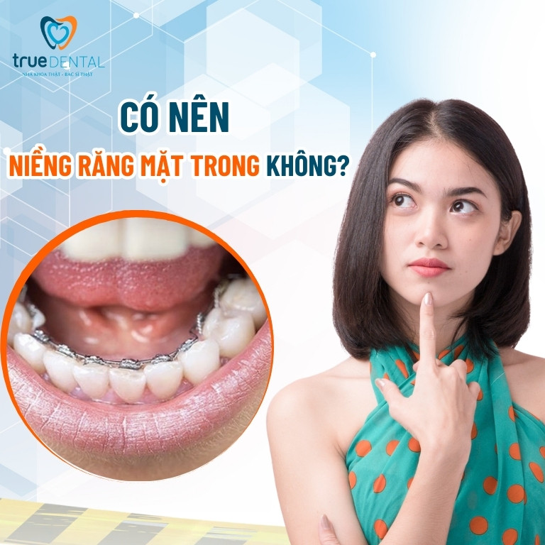 Có nên niềng răng mặt trong không?