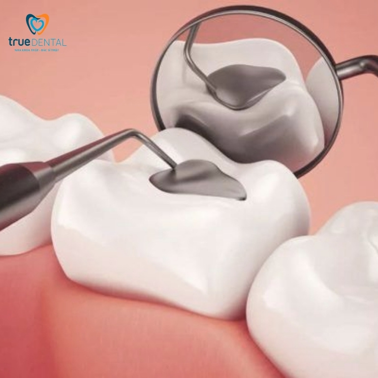 Có nên trám răng sâu cho trẻ em hay không? Trường hợp cần trám 6 Trám răng điều trị