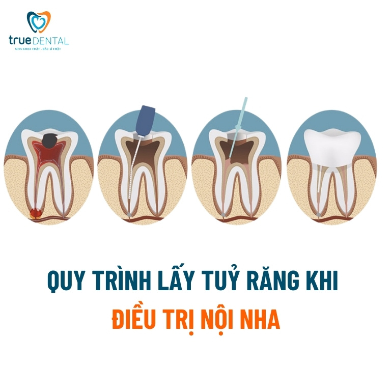 Điều trị nội nha là gì? Khi nào cần điều trị nội nha? 4 Quy trình điều trị nội nha