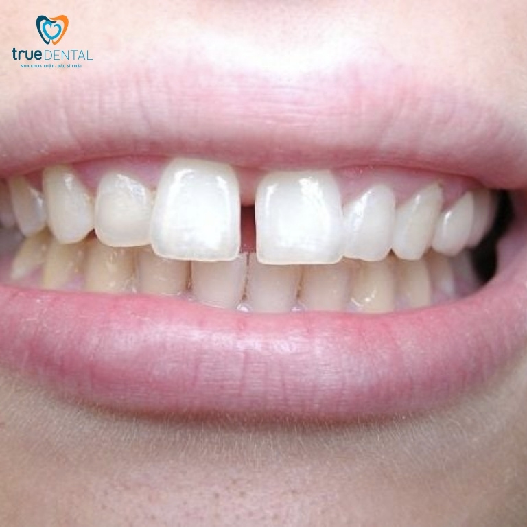 Bị hở răng cửa nên làm gì? Cách khắc phục hiệu quả 4 Răng cửa bị hở phải làm thế nào?