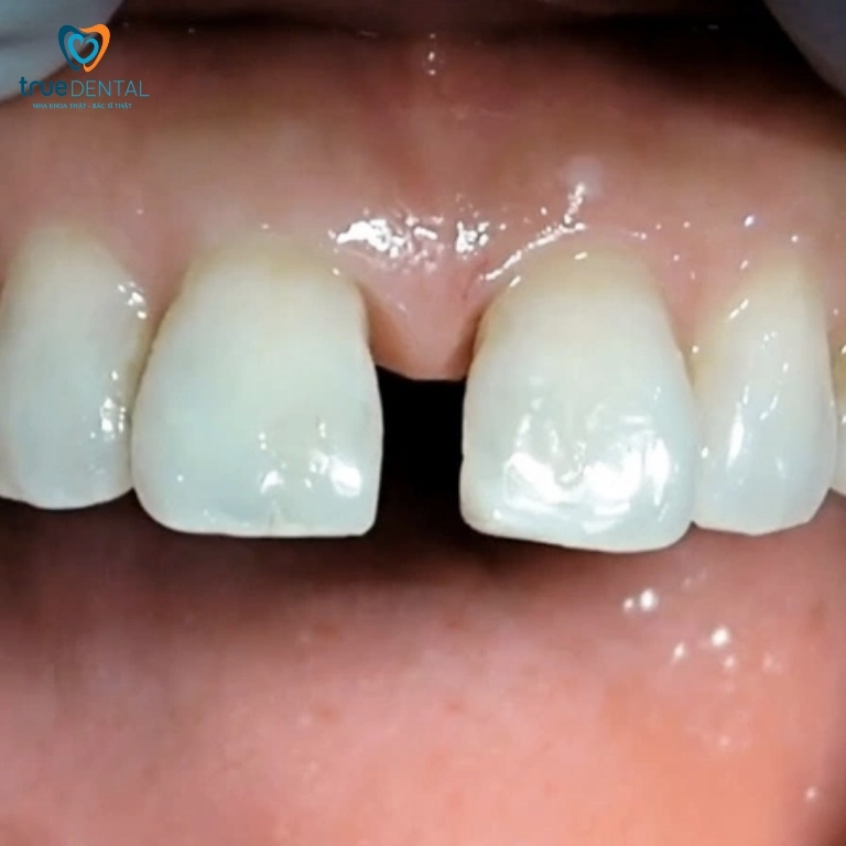 Bị hở răng cửa nên làm gì? Cách khắc phục hiệu quả 2 Nguyên nhân gây hở kẻ răng cửa