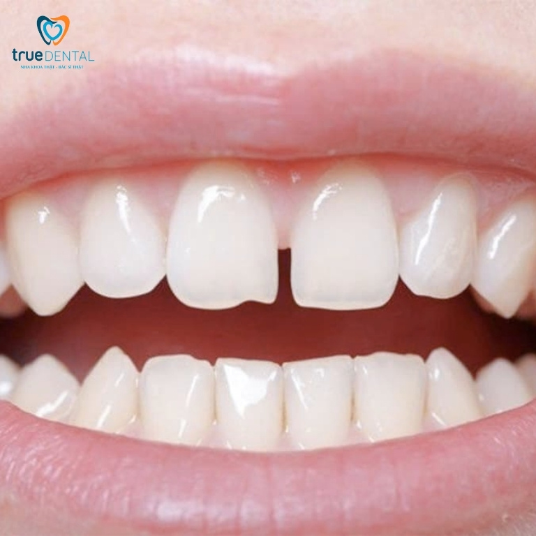 Bị hở răng cửa nên làm gì? Cách khắc phục hiệu quả 1 Thế nào là hở răng cửa?