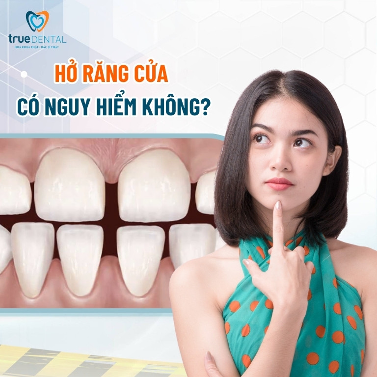 Bị hở răng cửa nên làm gì? Cách khắc phục hiệu quả 3 Hở răng cửa có nguy hiểm không? 5 tác hại cần biết