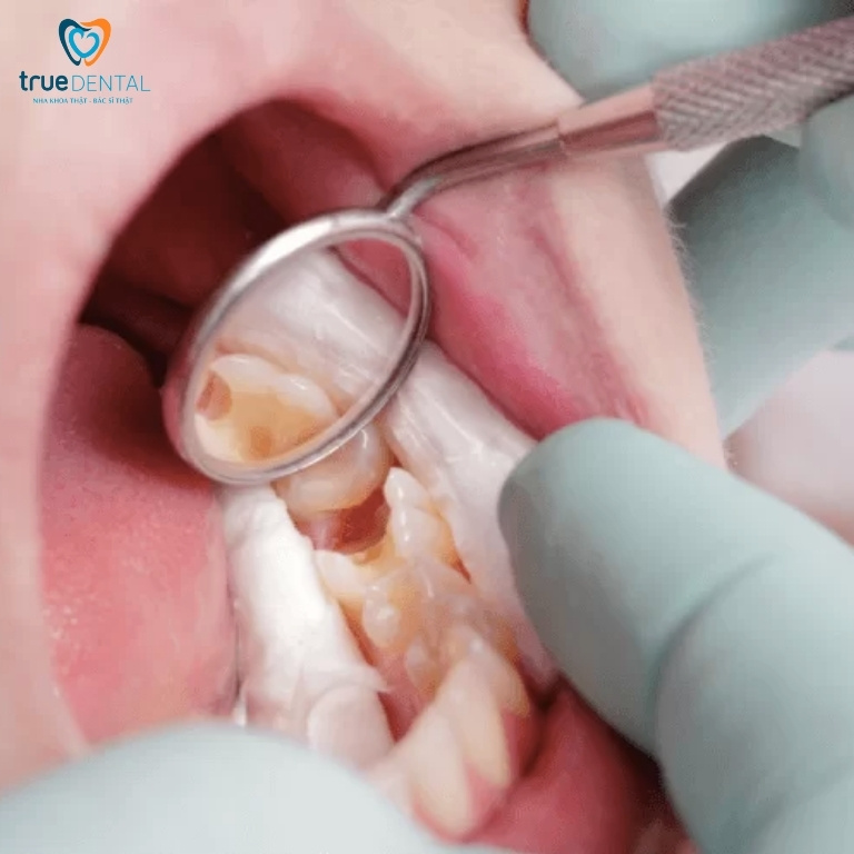 Lấy tủy răng mấy lần mới xong? Vì sao cần điều trị nhiều lần? 1 Vì sao cần phải lấy tủy răng?