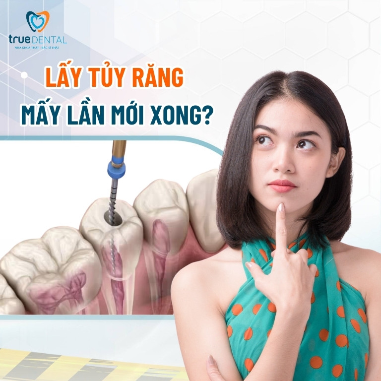 Lấy tủy răng mấy lần mới xong? Vì sao cần điều trị nhiều lần? 2 Lấy tủy răng mấy lần mới xong?